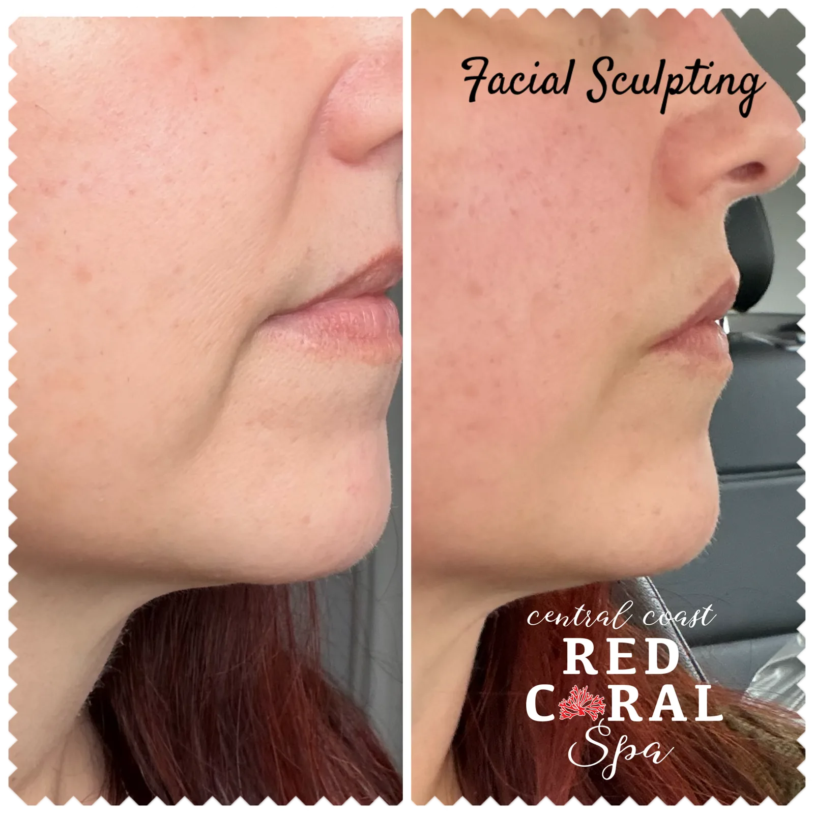 Before and after Facial Sculpting — jawline definition and lift