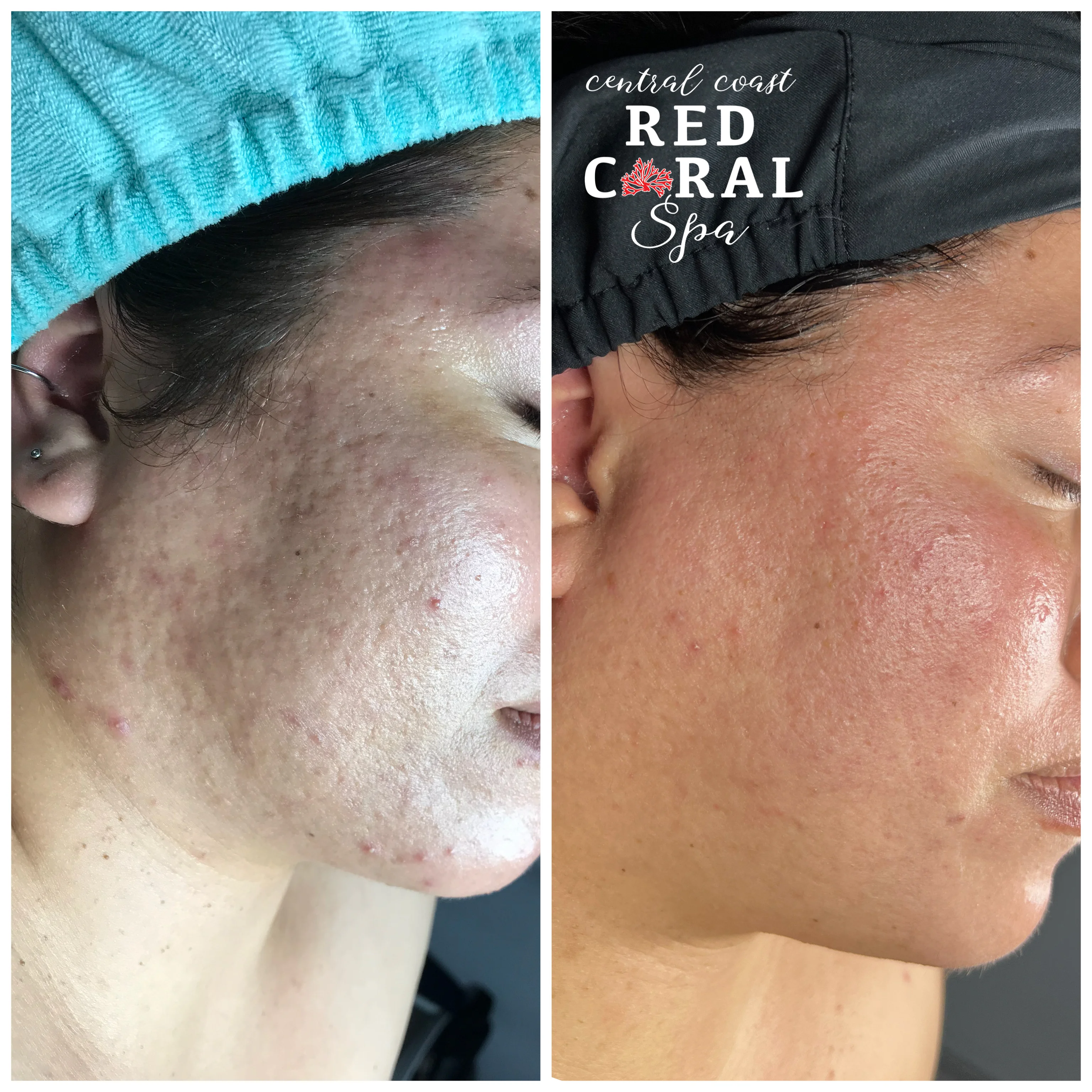 Karina — before and after results